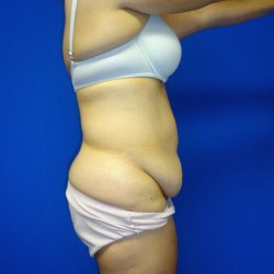 Manhattan abdominoplasty before 13